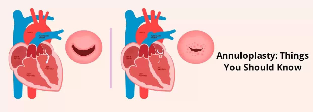 Annuloplasty: Things You Should Know
