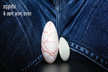 हाइड्रोसील के लक्षण, कारण, उपचार