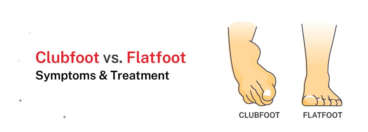 Clubfoot vs. Flatfoot: Symptoms & Treatment