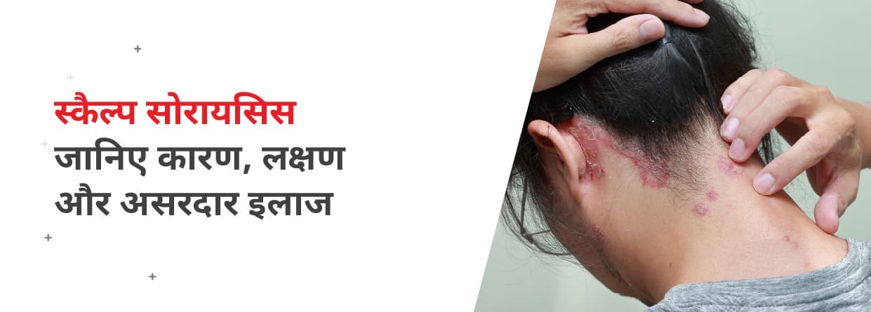 स्कैल्प सोरायसिस: जानिए कारण, लक्षण और असरदार इलाज