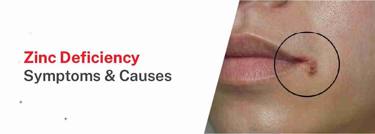 Zinc deficiency: symptoms & causes