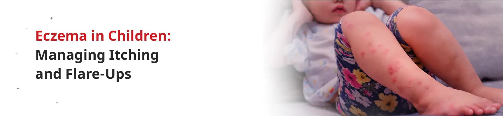 Eczema in Children: Managing Itching and Flare-Ups