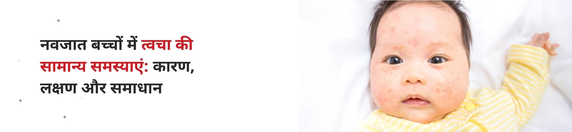 नवजात बच्चों में त्वचा की सामान्य समस्याएं: कारण, लक्षण और समाधान