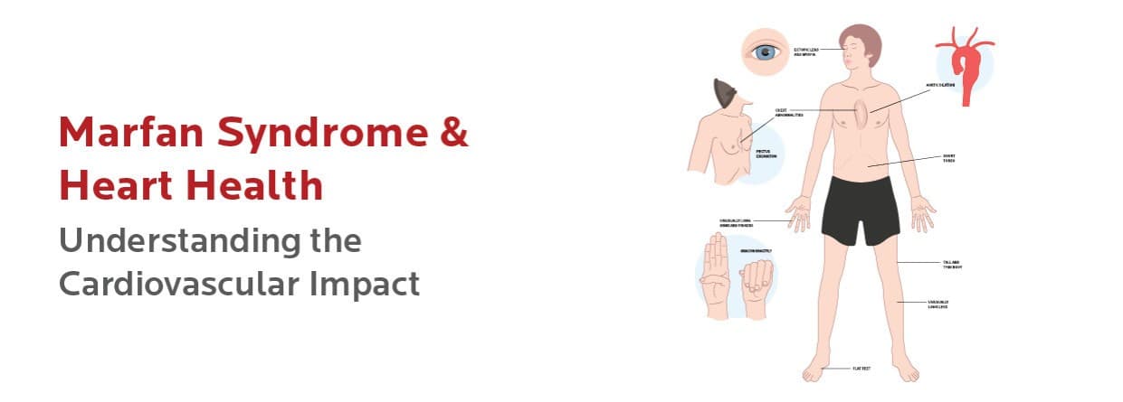 Marfan Syndrome & Heart Health: Understanding the Cardiovascular Impact