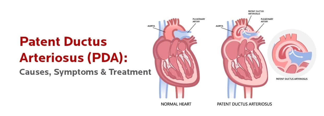 Patent Ductus Arteriosus (PDA): Causes, Symptoms & Treatment