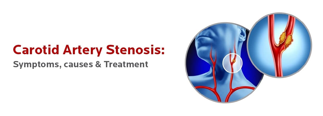 Carotid Artery Stenosis: Symptoms, causes & Treatment