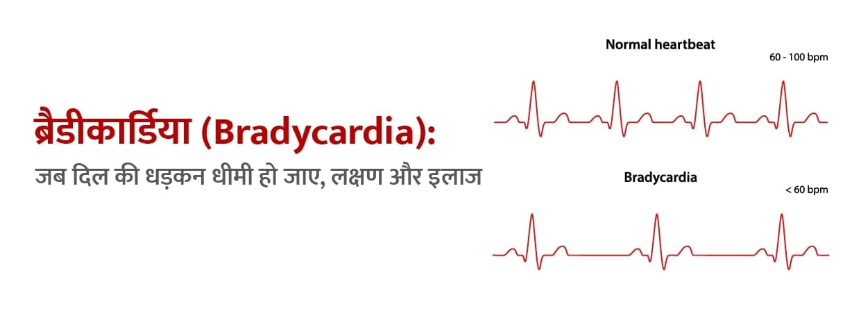 ब्रैडीकार्डिया (Bradycardia): जब दिल की धड़कन धीमी हो जाए, लक्षण और इलाज