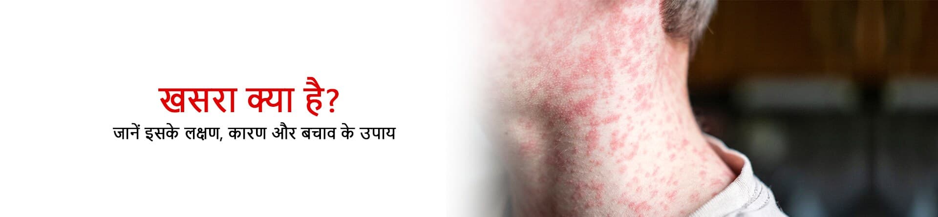 खसरा क्या है? जानें इसके लक्षण, कारण और बचाव के उपाय