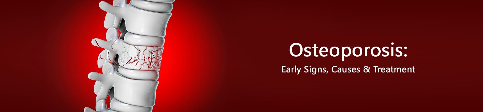 Osteoporosis: Early Signs, causes & Treatment