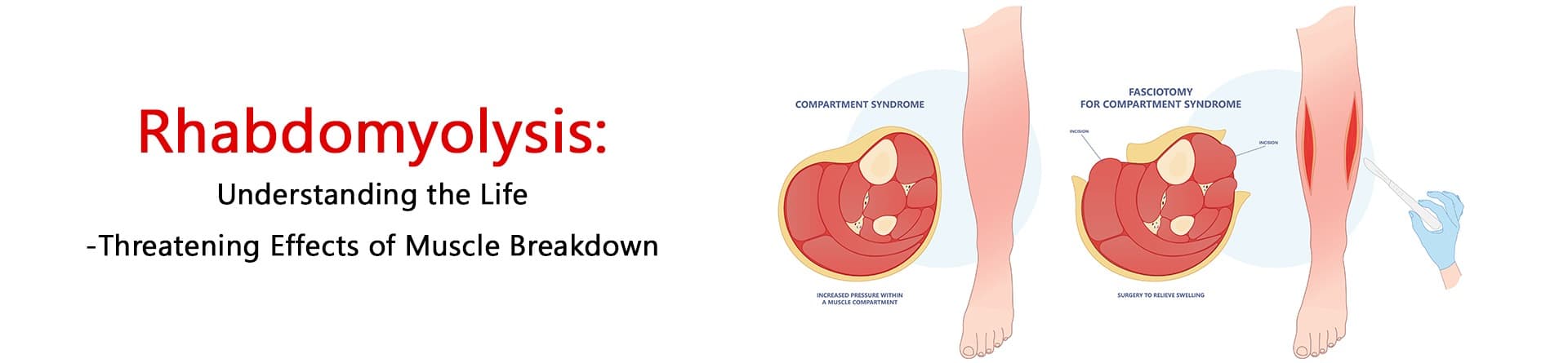 Rhabdomyolysis: Understanding the Life-Threatening Effects of Muscle Breakdown