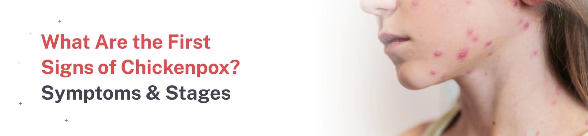 What Are the First Signs of Chickenpox? Symptoms & Stages