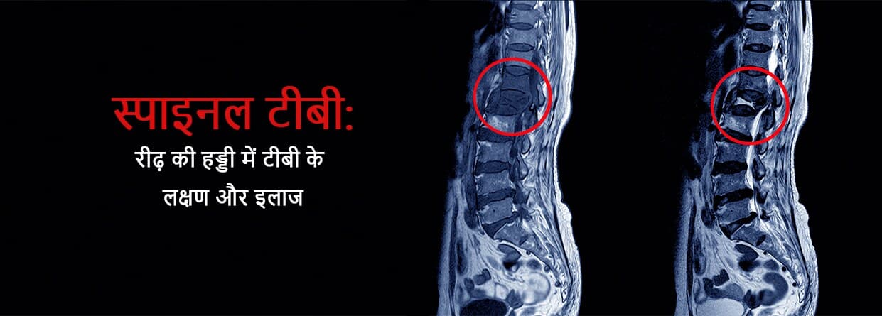 स्पाइनल टीबी: रीढ़ की हड्डी में टीबी के लक्षण और इलाज
