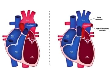 TGA : Understanding the Condition & Life-Saving Treatments