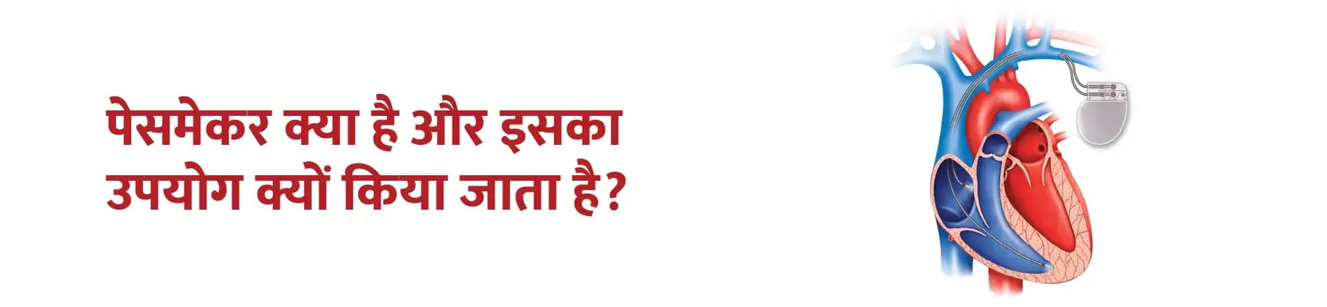 पेसमेकर क्या है और इसका उपयोग क्यों किया जाता है?