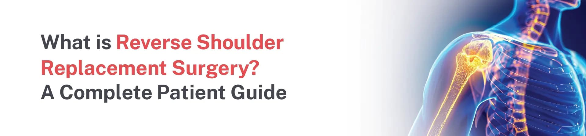 What Is Reverse Shoulder Replacement Surgery? A Complete Patient Guide