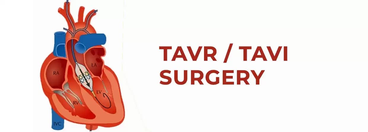 Transcatheter Aortic Valve Replacement (TAVI/TAVR): All You Need to Know