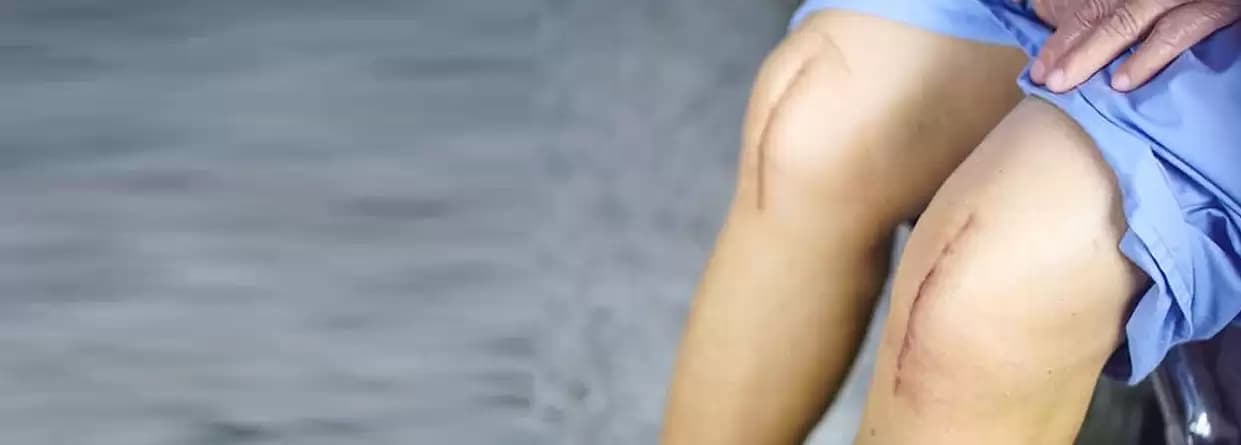 What is Total Knee Arthroplasty