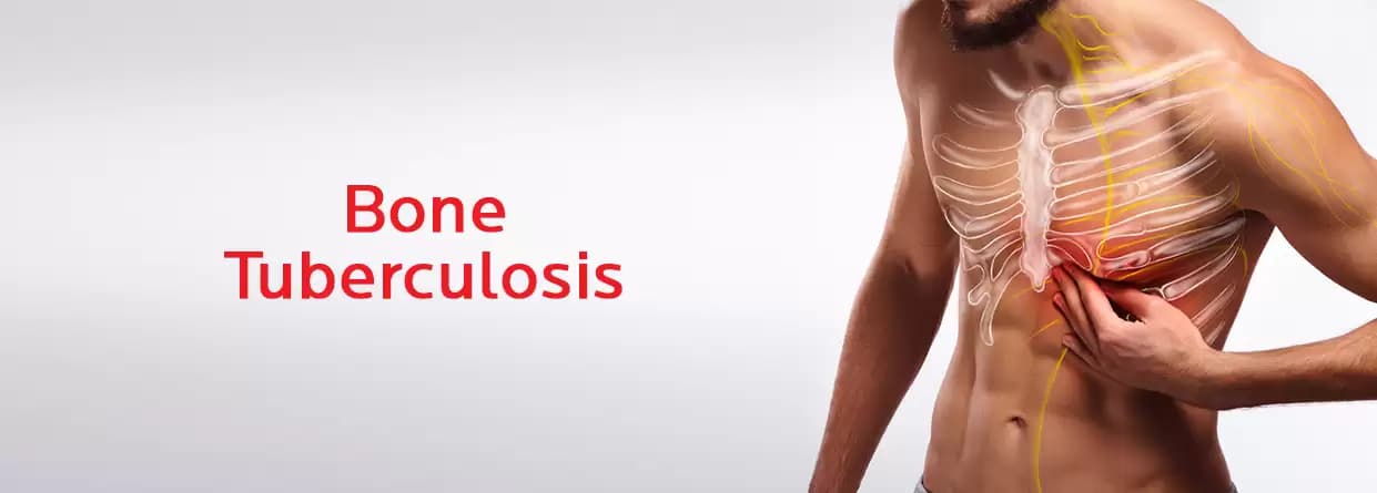 A Comprehensive Guide for Patients Fighting Bone Tuberculosis