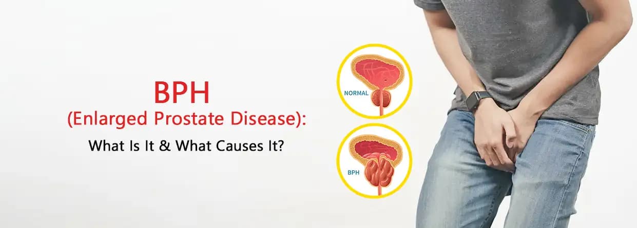 Benign Prostatic Hyperplasia (BPH): Causes, Symptoms & Treatment
