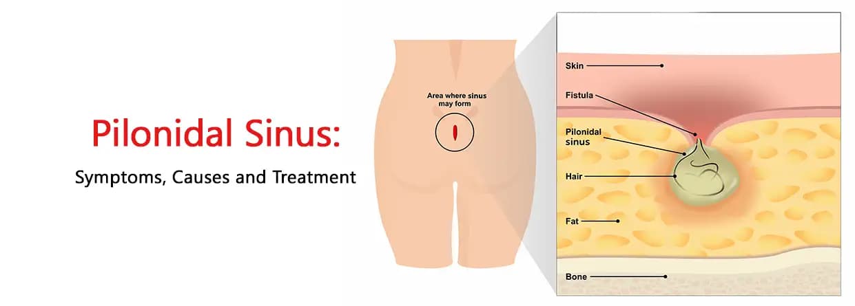 Pilonidal Sinus: Symptom, causes and Treatment