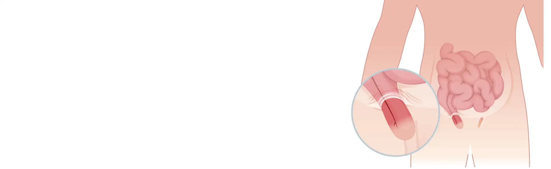 Inguinal Hernia Treatment