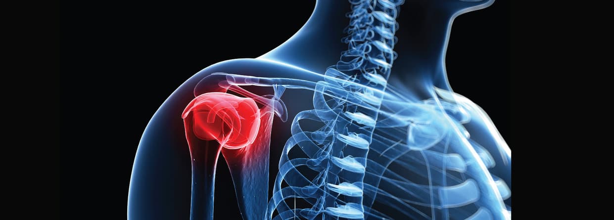 Rotator Cuff Injuries