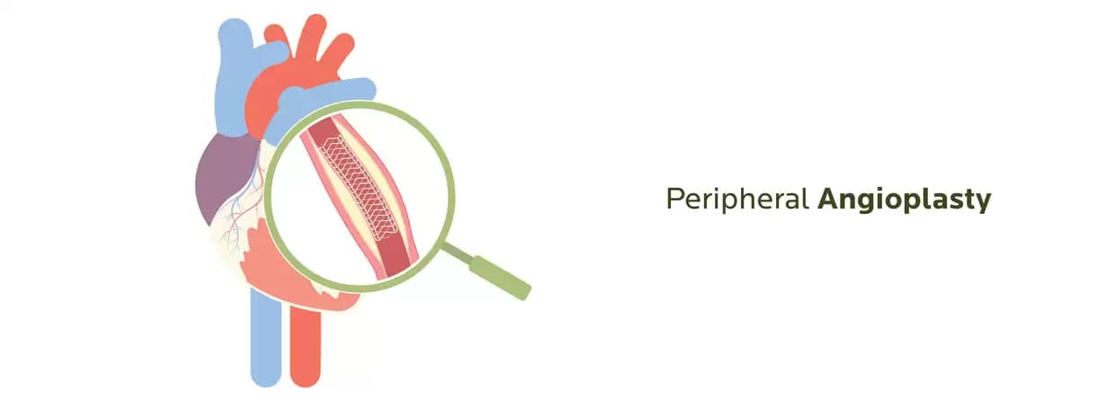 Case - Peripheral Angioplasty Report