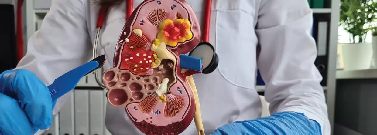 Everything You Need to Know About Kidney Cyst Removal