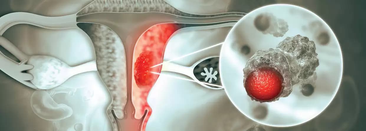 Know All About Endometrial Cancer