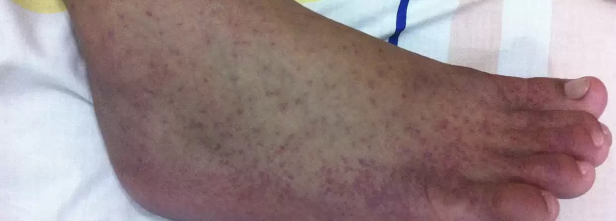 Chikungunya: Causes, Symptoms, Treatment, Prevention, Complications, And Vaccines