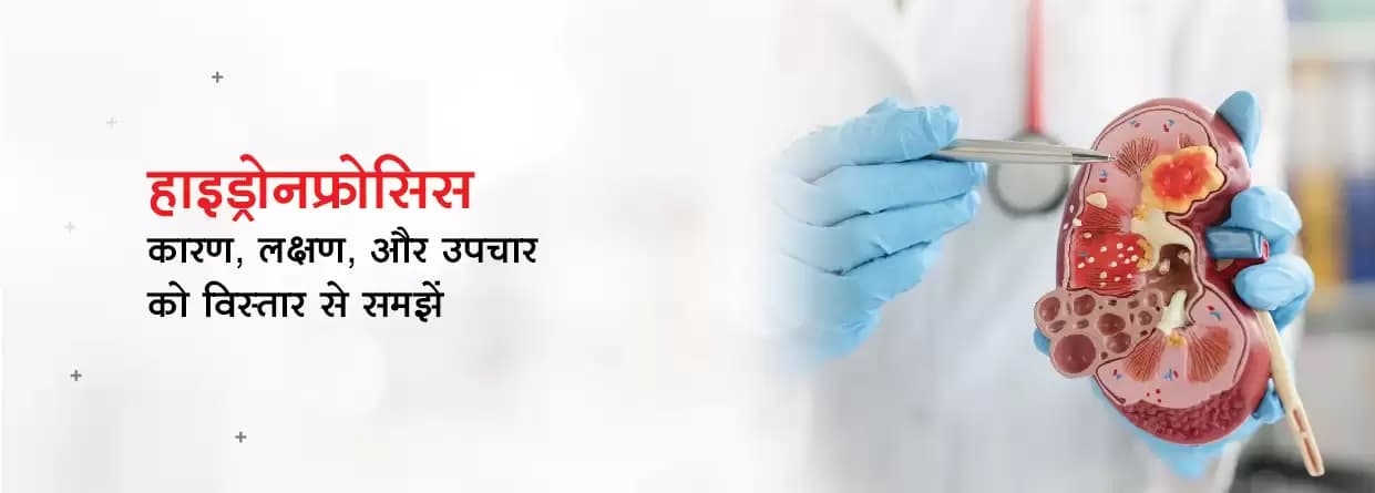 हाइड्रोनफ्रोसिस: कारण, लक्षण, और उपचार के विस्तार से समझें