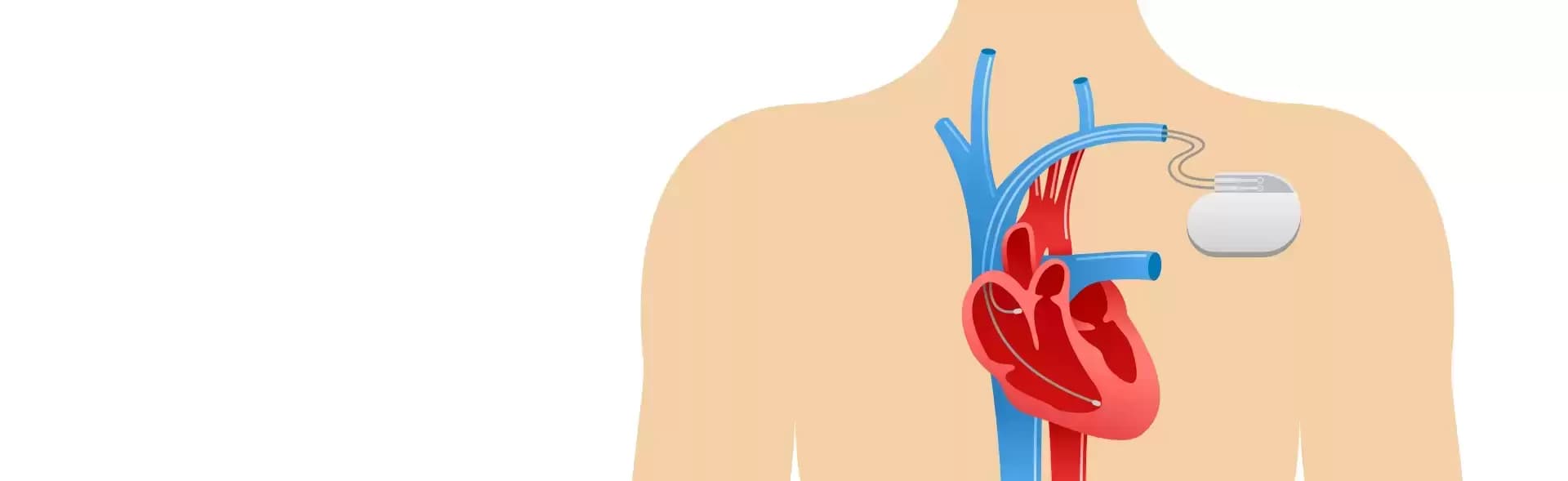 Pacemaker Implantation