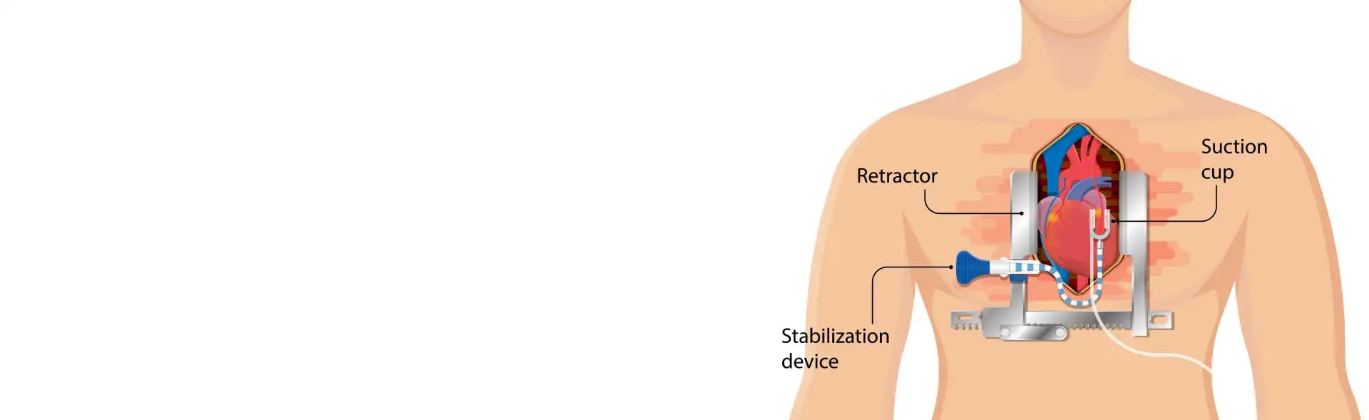 Septal Myectomy Surgery