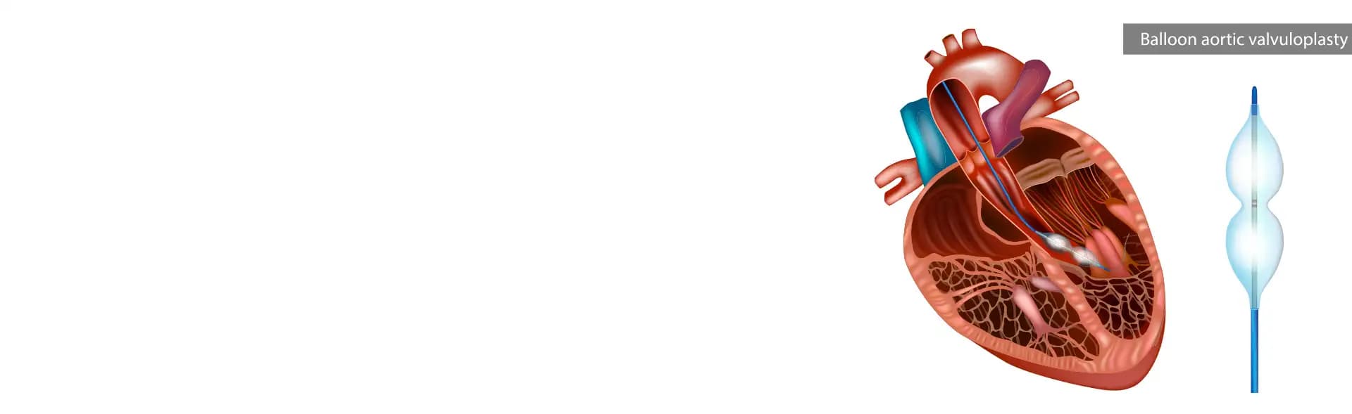 Mitral Valve Replacement