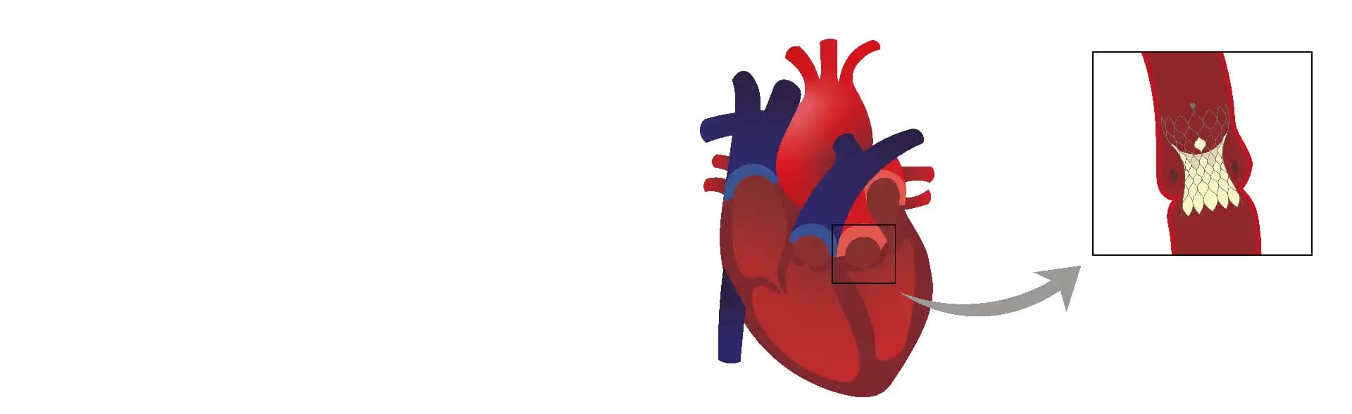 Heart Valve Replacement Surgery