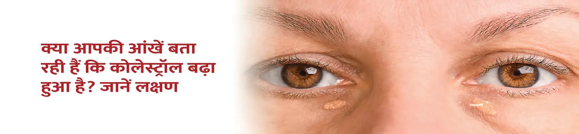क्या आपकी आंखें बता रही हैं कि कोलेस्ट्रॉल बढ़ा हुआ है? जानें लक्षण