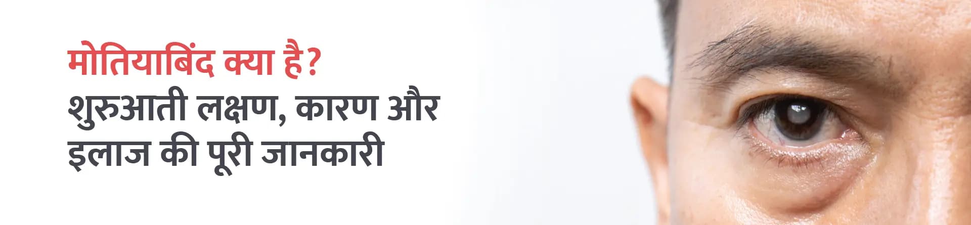 मोतियाबिंद क्या है? शुरुआती लक्षण, कारण और इलाज की पूरी जानकारी