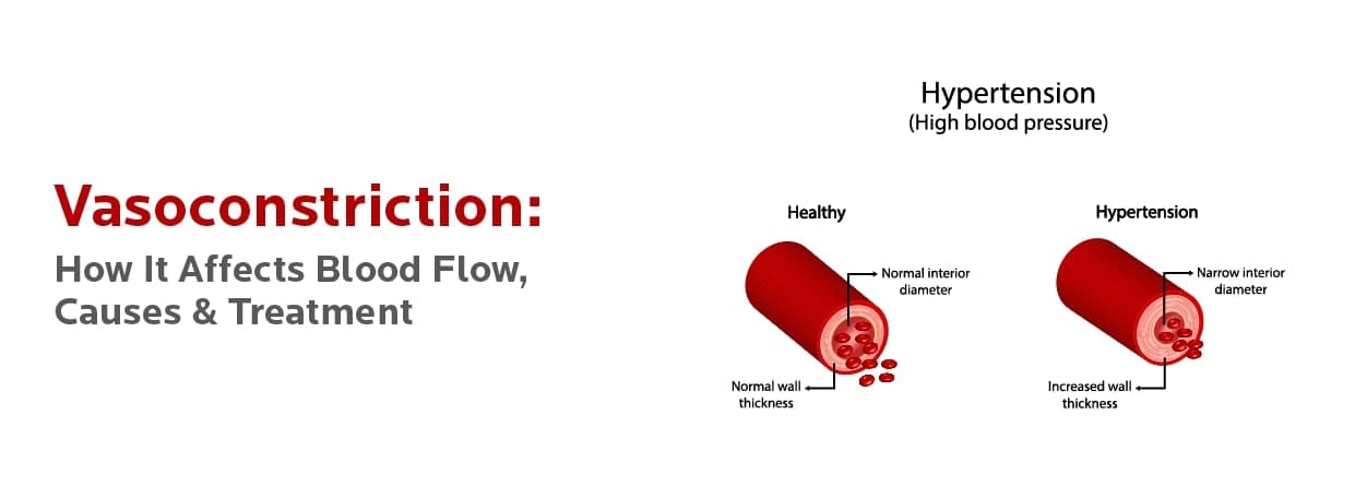 Vasoconstriction: How It Affects Blood Flow, Causes & Treatment