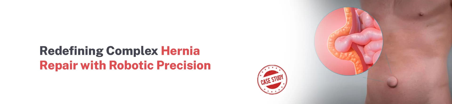 Redefining Complex Hernia Repair with Robotic Precision