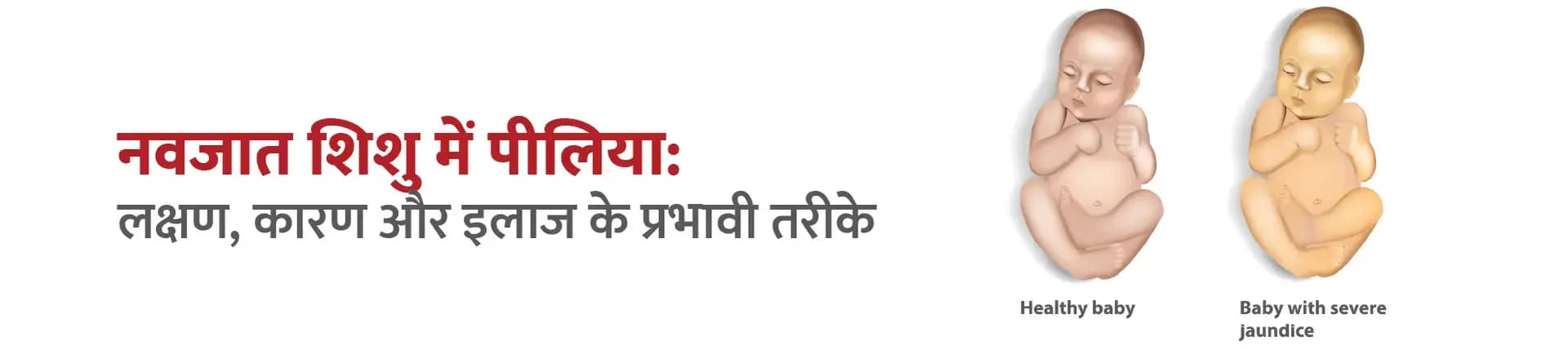 नवजात शिशु में पीलिया: लक्षण, कारण और इलाज के प्रभावी तरीके