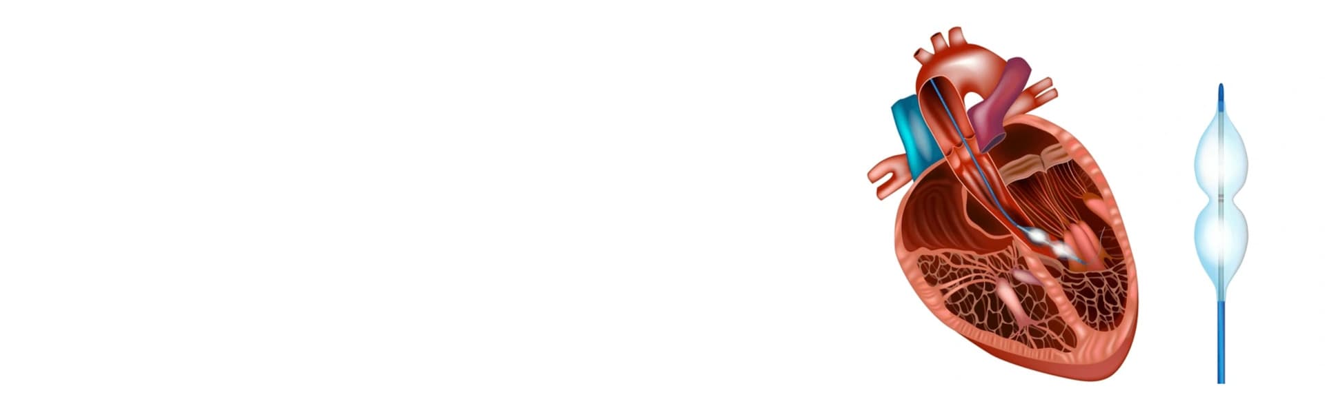 Balloon Valvuloplasty