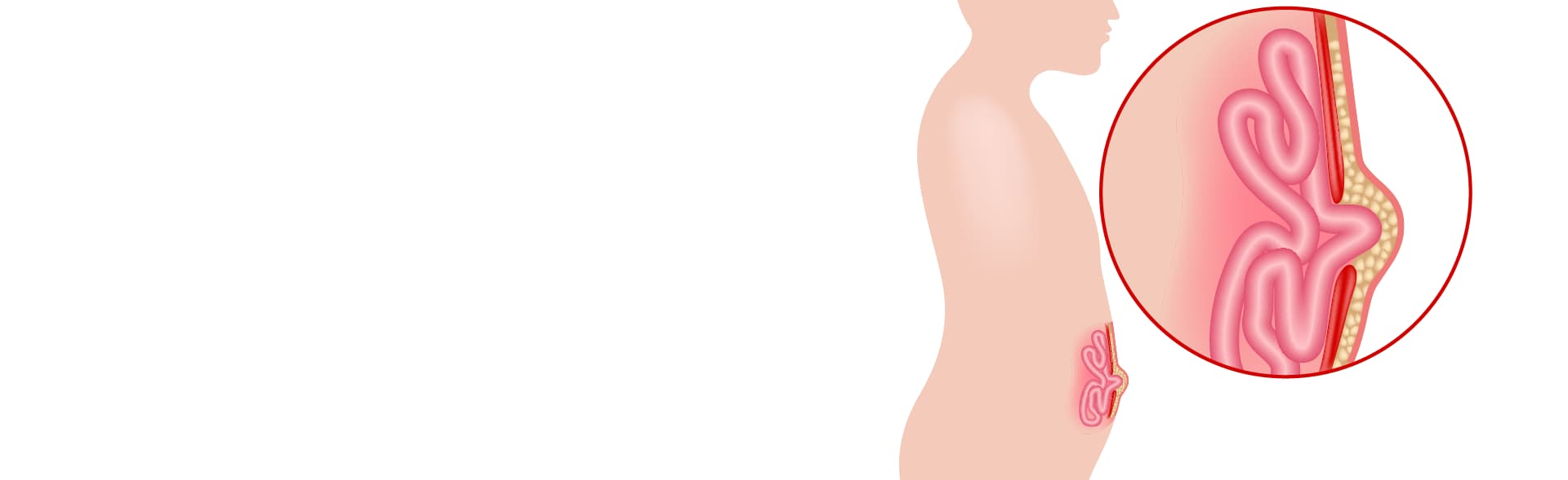 Umbilical Hernia Treatment