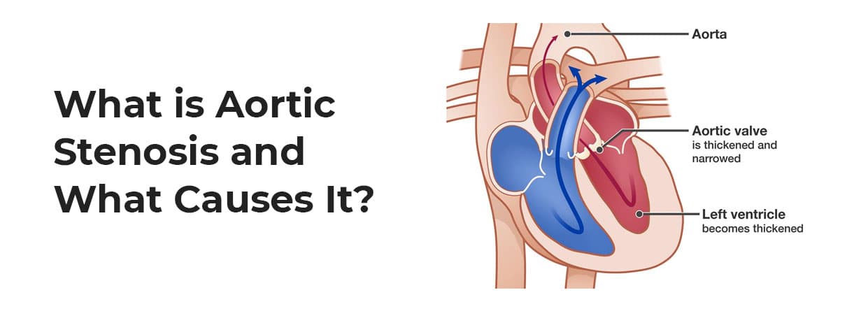 What is Aortic Stenosis and What Causes It?