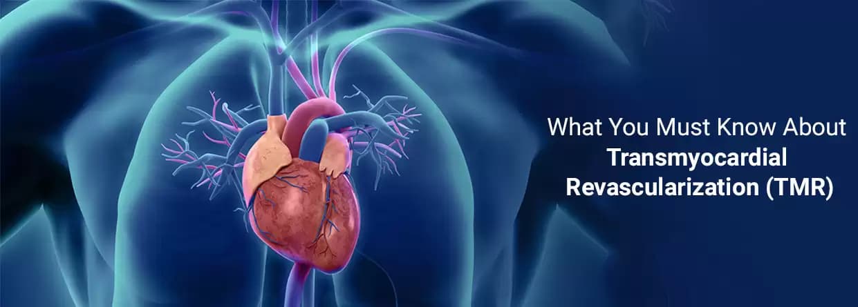 What You Must Know About Transmyocardial revascularization (TMR)