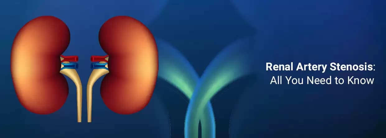 Renal Artery Stenosis: All You Need to Know