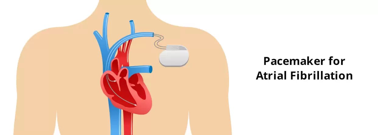 Atrial Fibrillation - Is Pacemaker An Effective Choice
