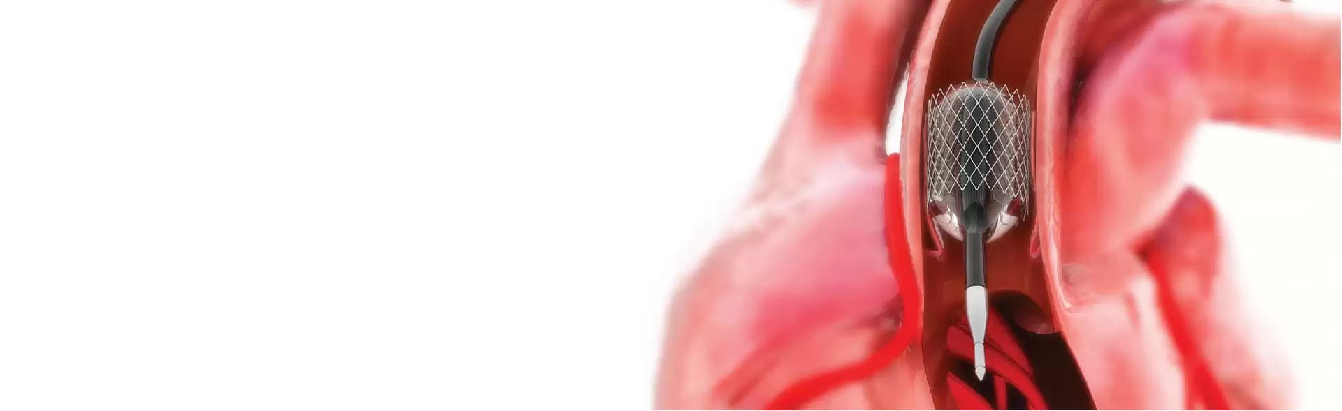 Coronary Angioplasty