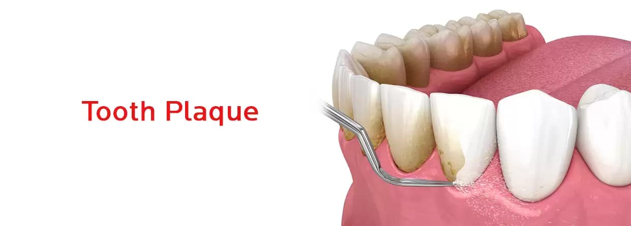 Tooth plaque- Everything You Need to Know
