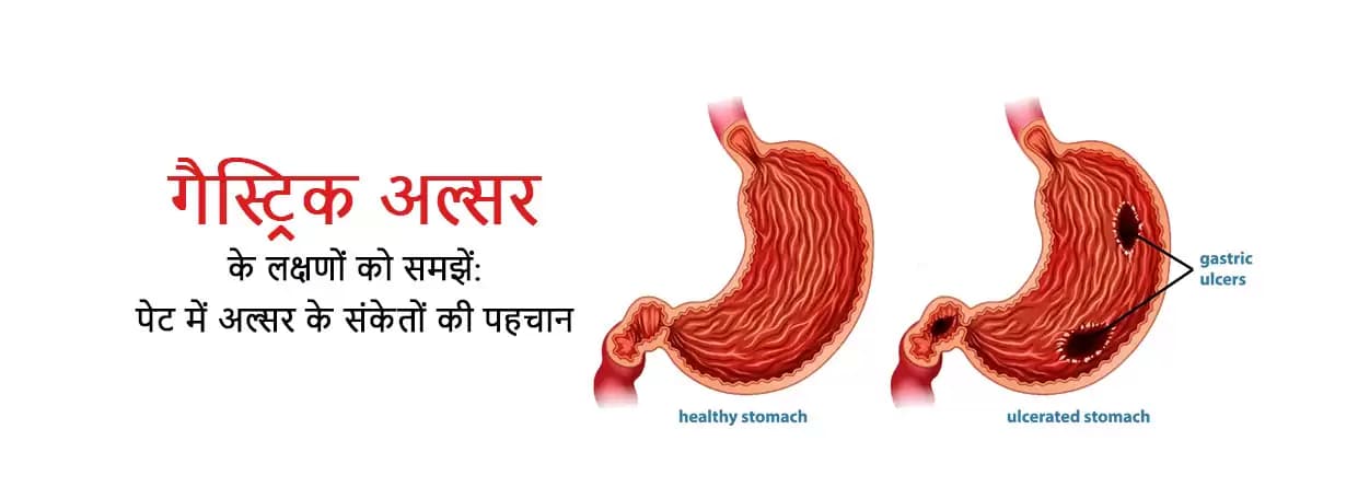 गैस्ट्रिक अल्सर: पेट में अल्सर के लक्षणों को समझें