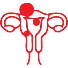 Uterine fibroids